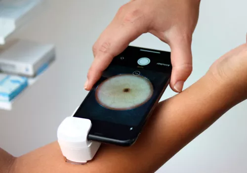 Télédermatologie